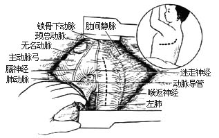 未闭动脉导管结扎术和切断缝合术