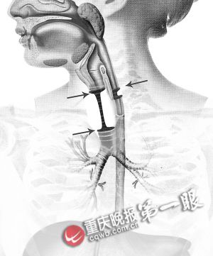 男孩气管断成两段缺了一半 仍被救活为全国首例