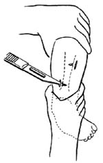 跟腱切断延长术