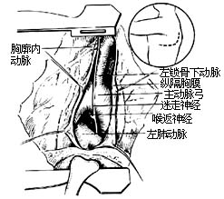 法乐四联症纠治术