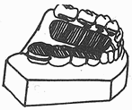 后牙反合