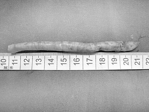 让高危患者远离中风——山东省聊城市脑科医院成功开展颈动脉内膜剥脱术掠影