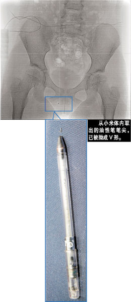 男生恶作剧在椅子上放笔 女生坐下笔尖戳入体内