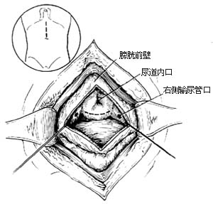 耻骨上经膀胱前列腺切除术