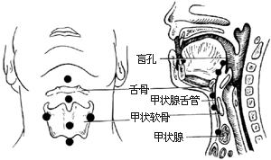 甲状腺舌管囊肿（瘘）切除术