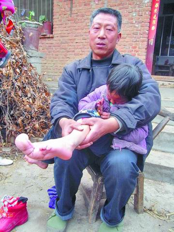 4岁女孩脚趾疯长 截趾手术后长势更旺