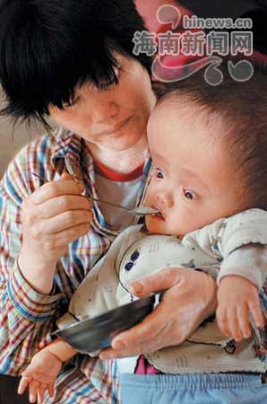 一岁婴儿患怪病脑袋比成人大
