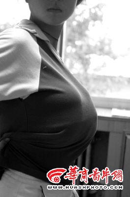 11岁女孩患巨乳症胸围92厘米