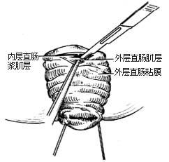 直肠脱垂经会阴切除术（Mikulicz）