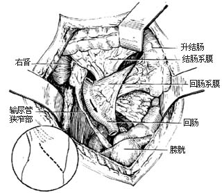 回肠代输尿管术