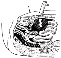 腹腔脓肿切开引流术