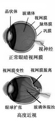 老人近视2500度 需同时佩戴隐形与框架眼镜