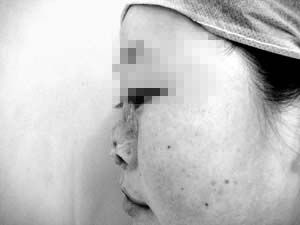内蒙古19岁鼻畸少女左上臂“种”出鼻子