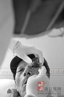 6旬老人眼皮上长肉角 形似土豆一碰就流血