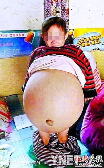 女童患怪病肚子大过孕妇 网友爱心接力助其来京治疗