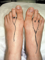 脚趾嫁接到手指 畸形手指变“纤纤玉指”