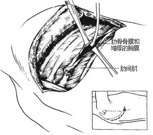 胸膜内胸廓成形术