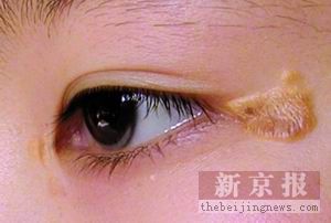 11岁女孩患上怪病 从小血管迅速衰老硬化