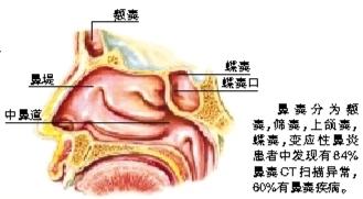 别把过敏当感冒 过敏性鼻炎的治疗和预防