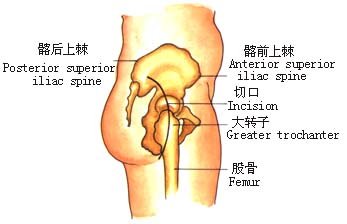 股骨颈骨折人工股骨头置换术