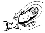 臂位阴道助产术