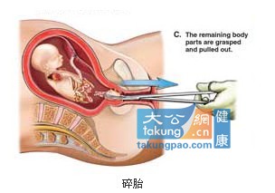 实拍堕胎手术全过程 呼吁珍惜生命
