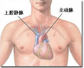 心脏移植术