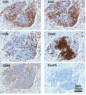 Scientific Reports：鉴定出上万名实体瘤患者中的独特免疫基因标记