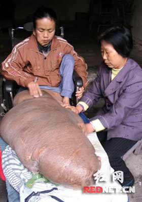 男子右腿长瘤70余公斤卧床18年