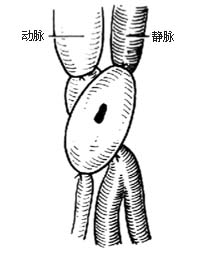外伤性动静脉瘘闭塞性手术