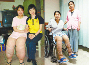 女孩患怪病双腿重100斤续：治愈后能穿仔裤