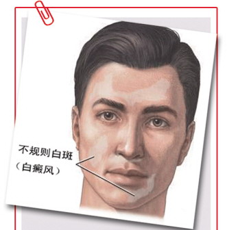白癜风：易诊断 难治疗