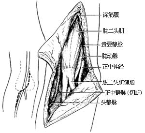 肱骨髁上骨折切开复位内固定术