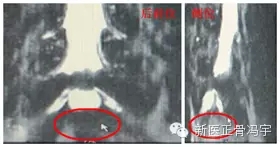 军医讲解：什么是腰椎管狭窄症