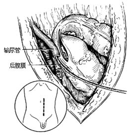 输尿管乙状结肠吻合术