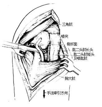 肱骨外科颈骨折切开复位内固定术