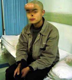 生下来被老鼠咬掉鼻子 十八年后终圆再造梦