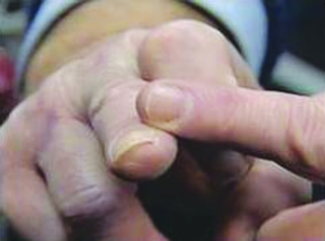 涂上特殊“再生粉末” 断指奇迹“再生”