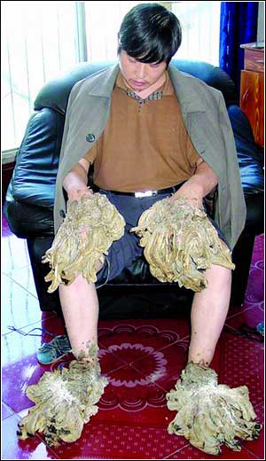 墩布手怪人京城康复 手脚曾像套上了墩布