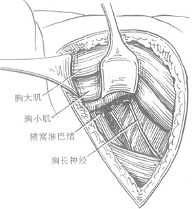 乳癌简化根治术