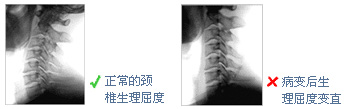 上班族必须知道的5个颈椎健康问题