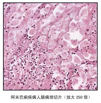 阿米巴痢疾病人肠病理切片（放大250倍）