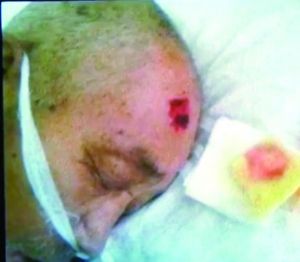 老人住院遭鼠咬次日身亡 院方称系脏器衰竭死亡