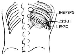 经后侧腹膜外肝脓肿切开引流术