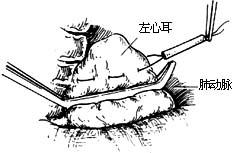 闭式二尖瓣交界分离术