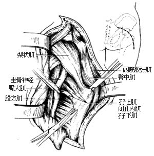 髋关节脱位切开复位术