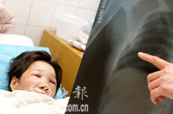 汽车撞倒聋哑老太筋骨尽断 三小时无人问津