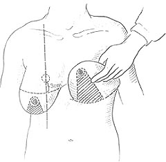 乳房缩小整形术