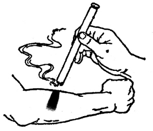 面瘫可用热敏灸（上）