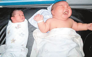 印尼41岁女子剖腹产8.7公斤巨婴